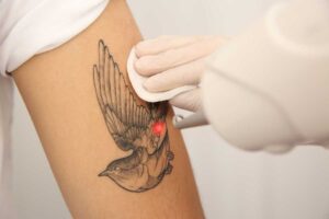 rimozione del tatuaggio tramite laser